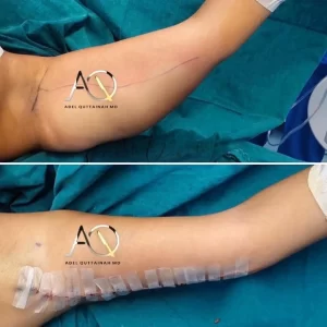 BRACHIOPLASTY before and after (3)