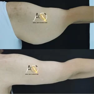 BRACHIOPLASTY before and after (5)