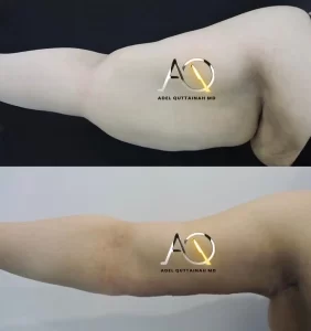 BRACHIOPLASTY before and after (6)