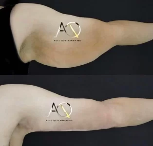 BRACHIOPLASTY before and after (7)