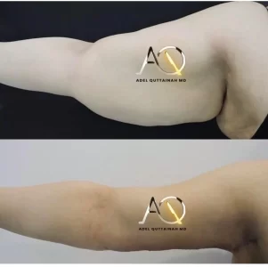 BRACHIOPLASTY before and after (9)