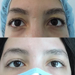 Blepharoplasty before and after (2)