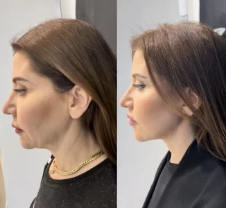 Facelift and necklift before and after (1)