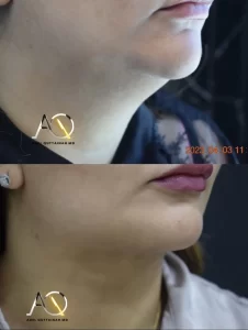 Facelift and necklift before and after (11)