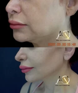 Facelift and necklift before and after (12)