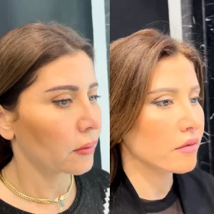 Facelift and necklift before and after (3)