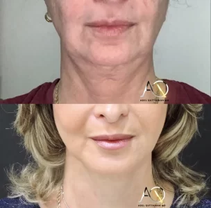 Facelift and necklift before and after (5)