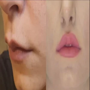 LIP LIFT BEFORE AND AFTER