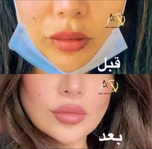 LIP LIFT before and after (2)