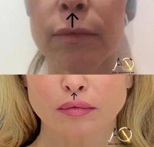 LIP LIFT before and after (5)