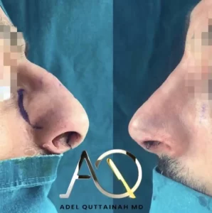 Rhinoplasty (10)