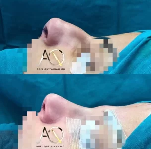 Rhinoplasty (3)
