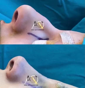 Rhinoplasty (7)