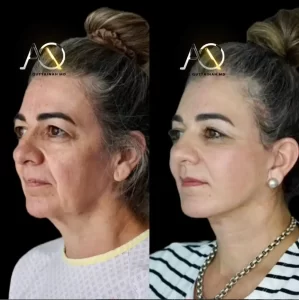 dr adel facelift result 2