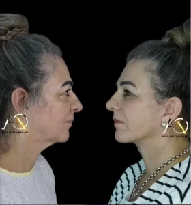 dr adel facelift result