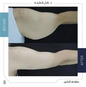 شد الذراعين 1